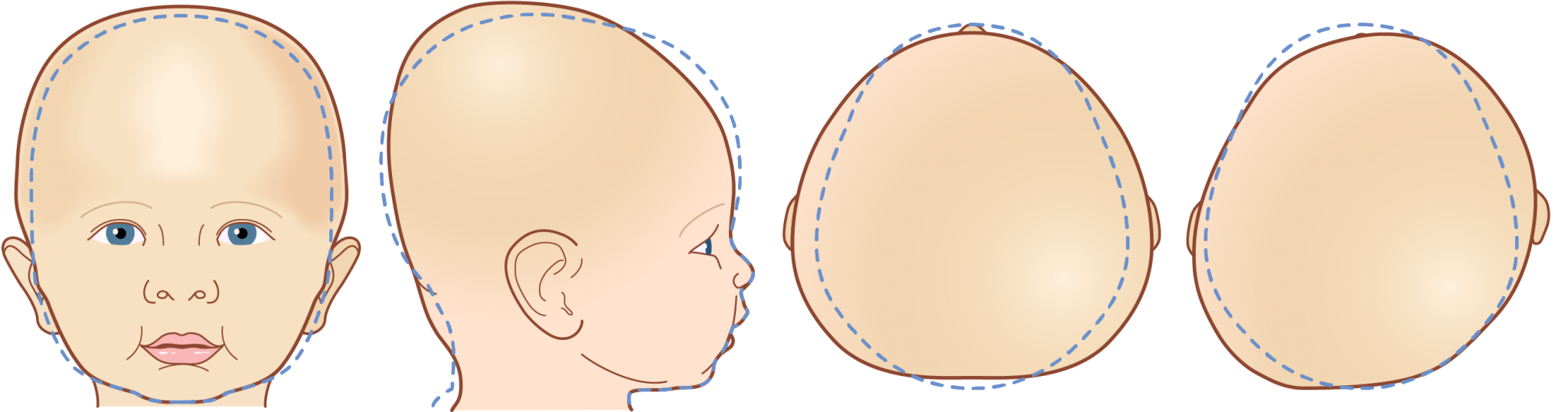 Owens Carolina is your pediatric cranial molding helmet specialist ...