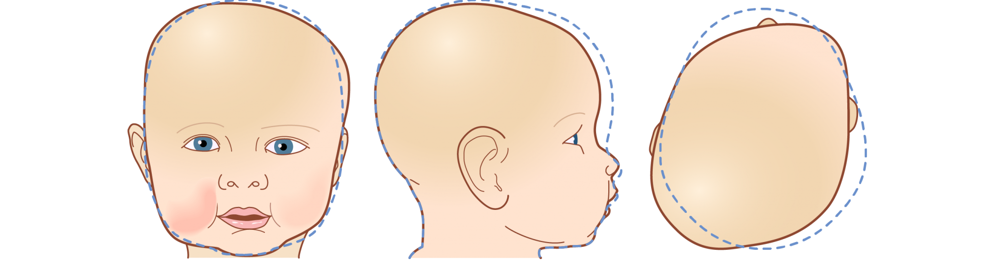 Owens Carolina is your pediatric cranial molding helmet specialist ...